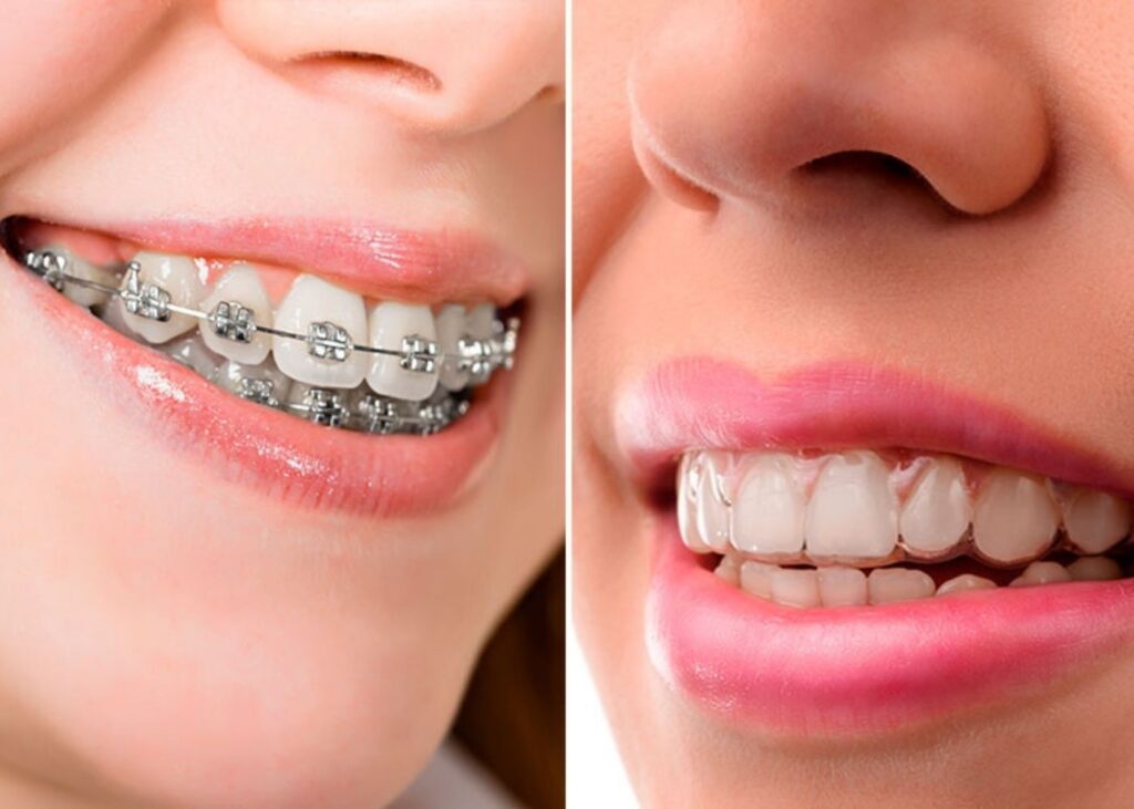 Brackets vs Alineadores Transparentes - Caravaca | Clínica Dental Doctores Gómez